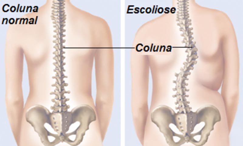 Médico explica: Escoliose, mais do que viver com a coluna aos 'ésses