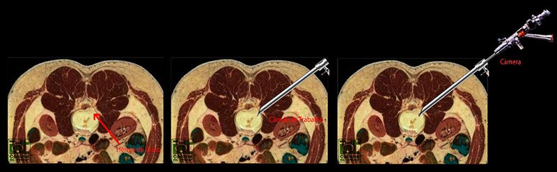 endoscopia de coluna cirurgia endoscopica 1