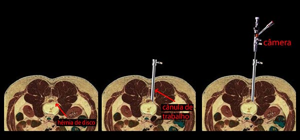 endoscopia de coluna cirurgia endoscopica 2