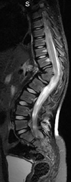 escoliose congenita 04