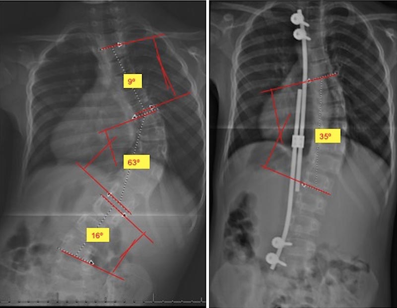 escoliose congenita 10