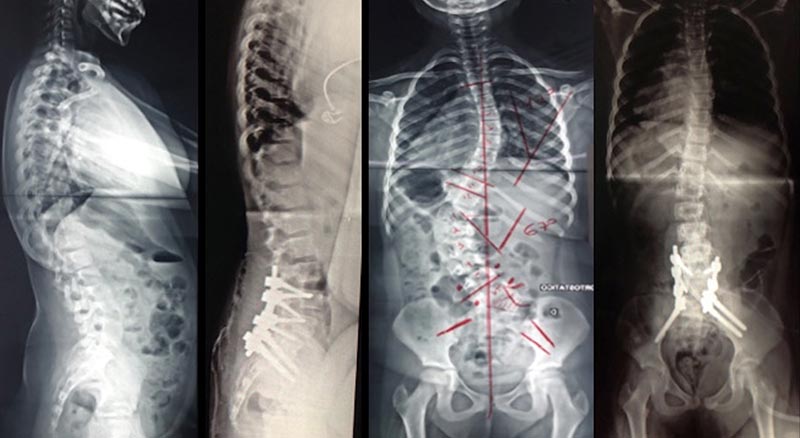 escoliose congenita 14