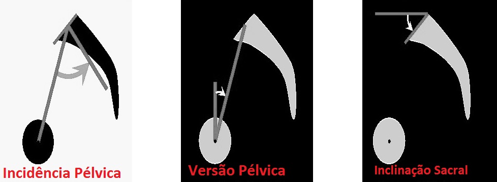 escoliose do adulto deformidade do adulto 3