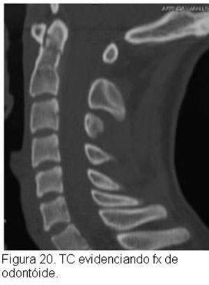 Fratura de coluna - (Afecções traumáticas da coluna vertebral)