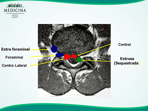 https://www.drfogaca.com.br/website/images/entenda_sua_doenca/hernia-discal-lombar-1.jpg