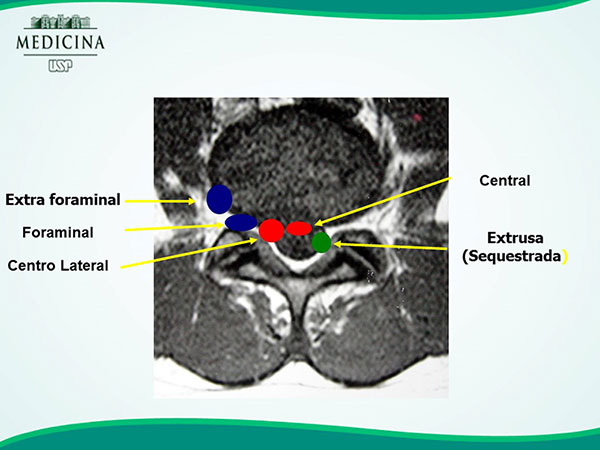 Hérnia Discal Lombar